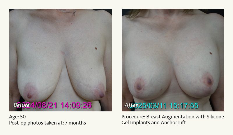 Breast Augmentation With Lift in Plano, TX - Patient 3