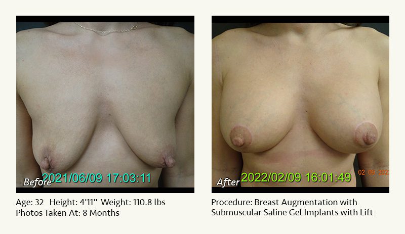 Breast Augmentation With Lift in Plano, TX - Patient 11