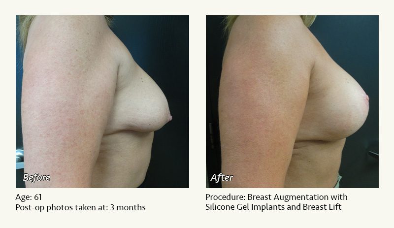 Breast Augmentation With Lift in Plano, TX - Patient 10