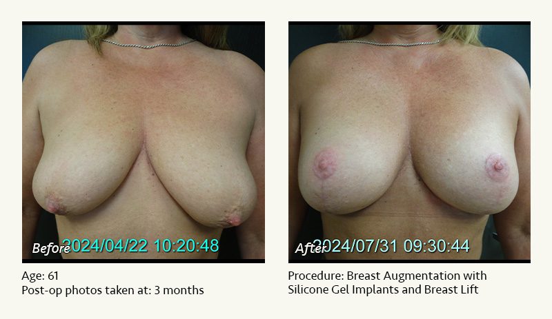 Breast Augmentation With Lift in Plano, TX - Patient 9