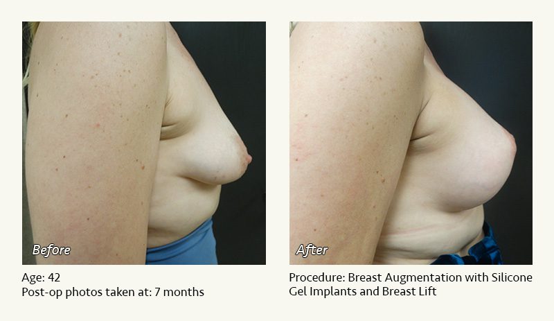Breast Augmentation With Lift in Plano, TX - Patient 8