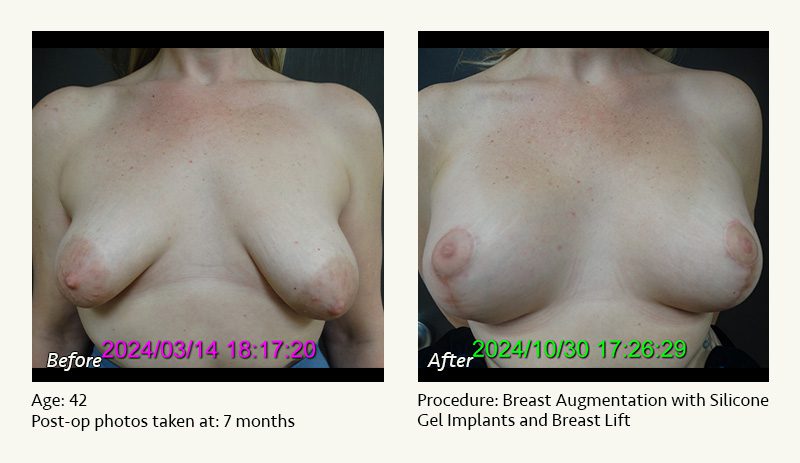 Breast Augmentation With Lift in Plano, TX - Patient 7