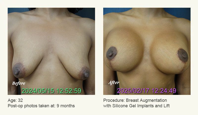 Breast Augmentation With Lift in Plano, TX - Patient 5