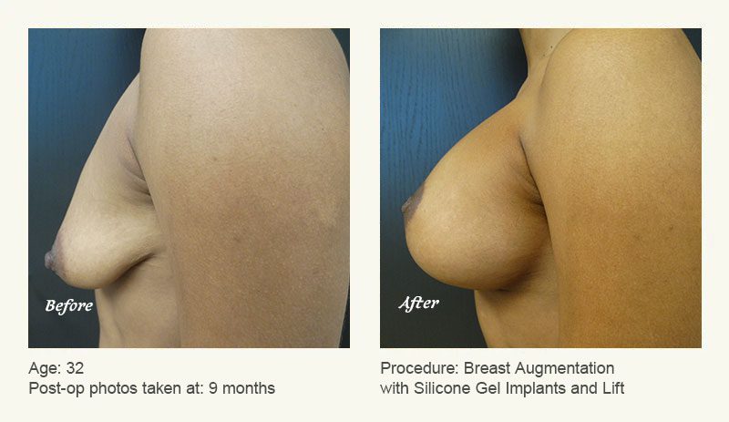 Breast Augmentation With Lift in Plano, TX - Patient 6