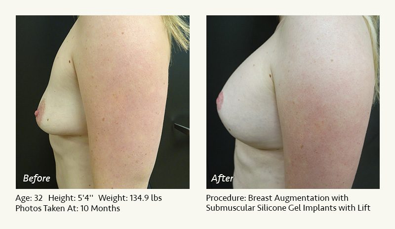 Breast Augmentation With Lift in Plano, TX - Patient 14
