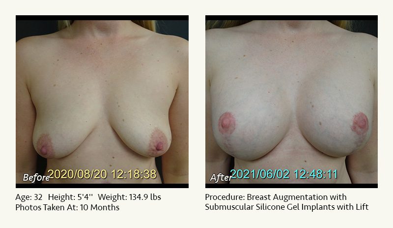 Breast Augmentation With Lift in Plano, TX - Patient 13