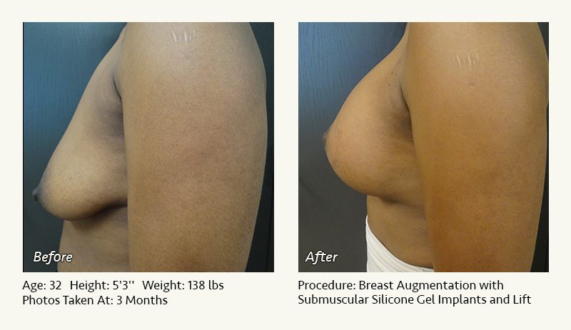 Breast Augmentation With Lift in Plano, TX - Patient 16