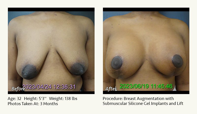 Breast Augmentation With Lift in Plano, TX - Patient 15