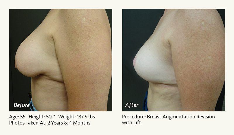 Breast Augmentation With Lift in Plano, TX - Patient 18