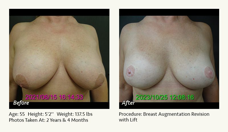 Breast Augmentation With Lift in Plano, TX - Patient 17
