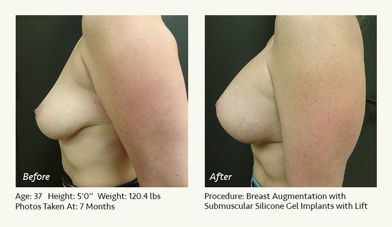 Breast Augmentation With Lift in Plano, TX - Patient 20