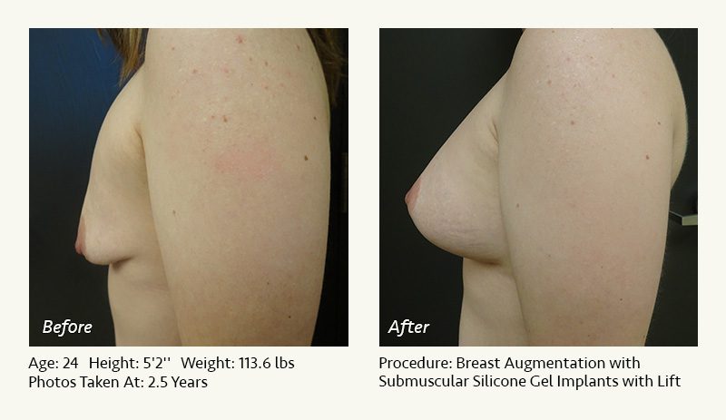 Breast Augmentation With Lift in Plano, TX - Patient 22