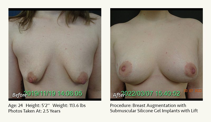 Breast Augmentation With Lift in Plano, TX - Patient 21