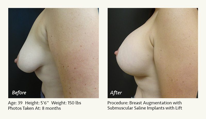 Breast Augmentation With Lift in Plano, TX - Patient 24