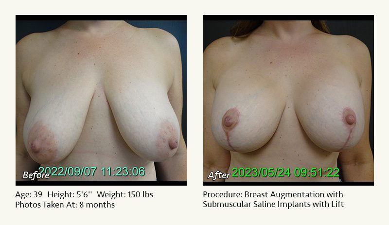 Breast Augmentation With Lift in Plano, TX - Patient 23