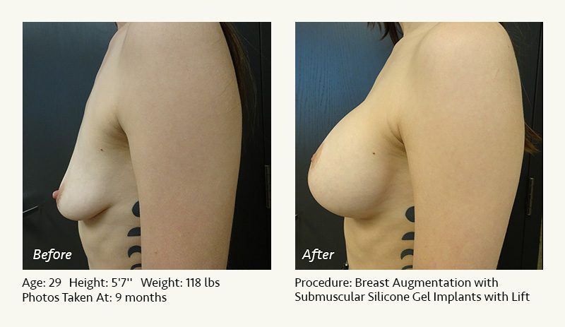 Breast Augmentation With Lift in Plano, TX - Patient 26