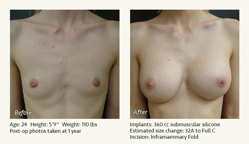 Breast Augmentation in Plano, TX - Patient 115