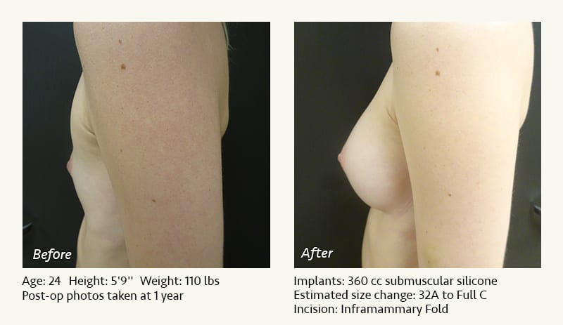 Breast Augmentation in Plano, TX - Patient 116