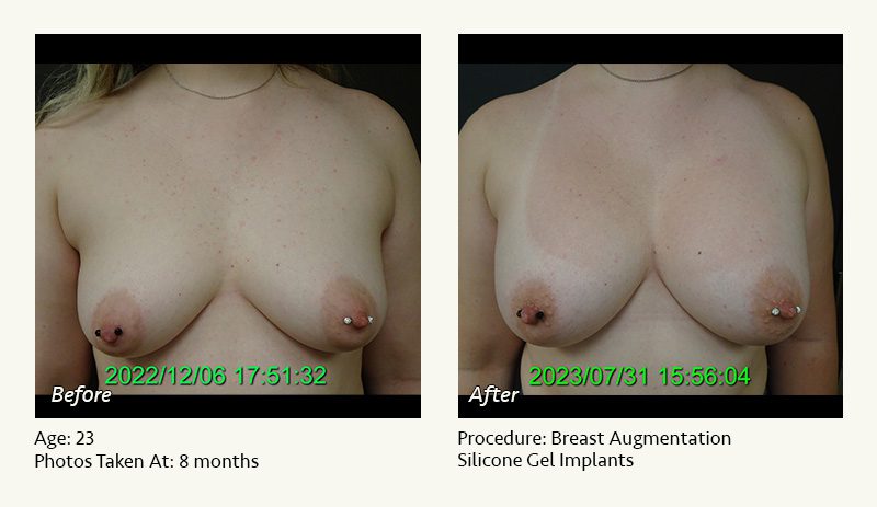 Breast Augmentation in Plano, TX - Patient 35