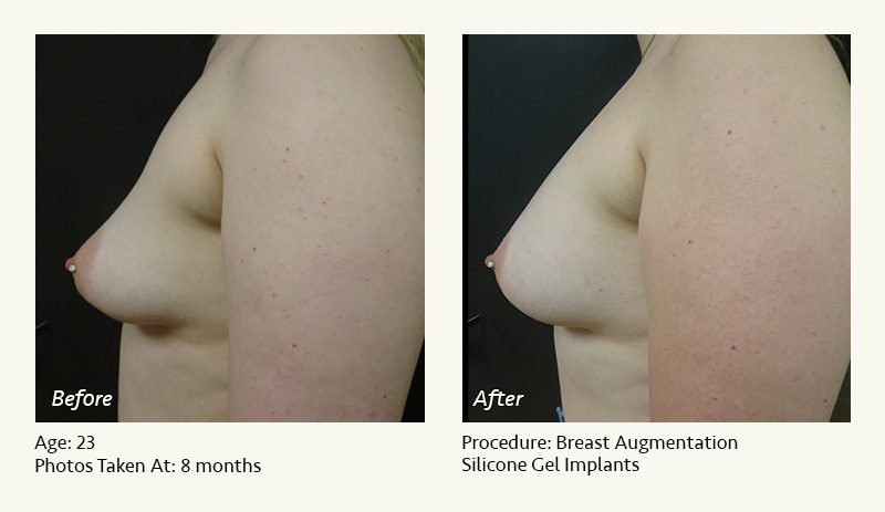 Breast Augmentation in Plano, TX - Patient 36