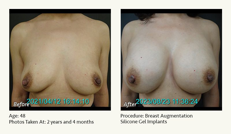 Breast Augmentation in Plano, TX - Patient 33
