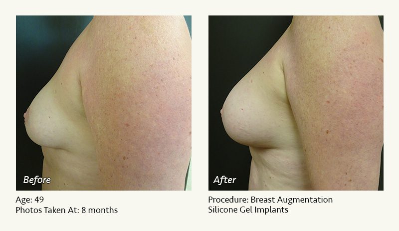 Breast Augmentation in Plano, TX - Patient 32