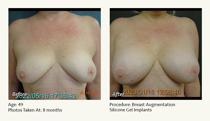 Breast Augmentation in Plano, TX - Patient 31