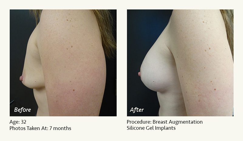 Enlarged correct breast surgery silicone implantation small size