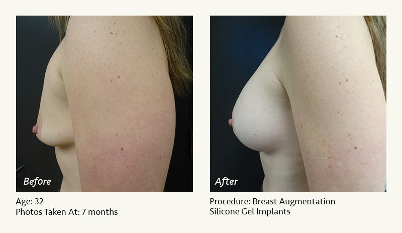 Breast Augmentation in Plano, TX - Patient 30