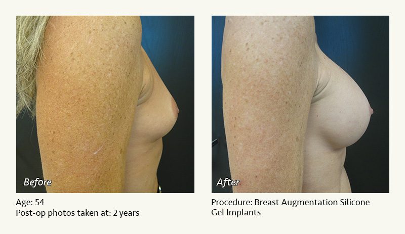 Breast Augmentation in Plano, TX - Patient 28