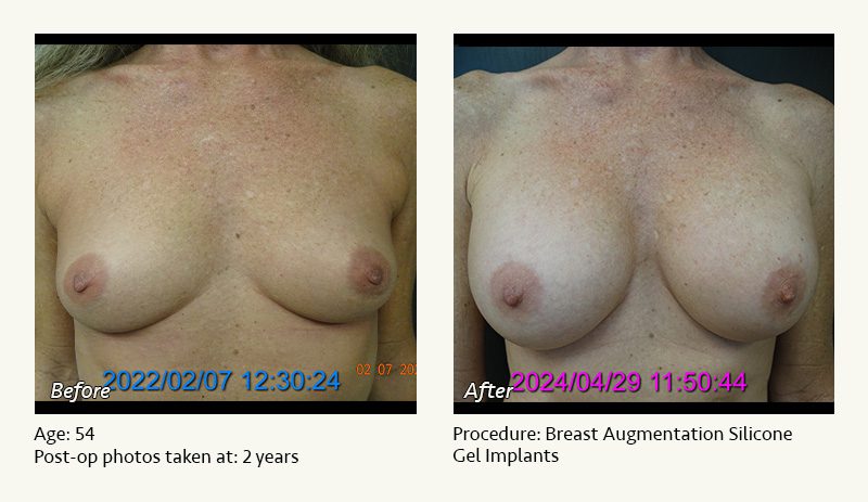 Breast Augmentation in Plano, TX - Patient 27