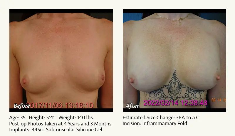 Breast Augmentation in Plano, TX - Patient 47