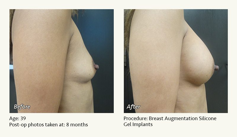 Breast Augmentation in Plano, TX - Patient 26