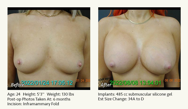 Breast Augmentation in Plano, TX - Patient 45