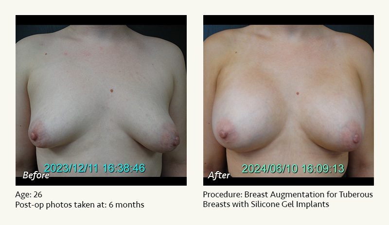 Breast Augmentation in Plano, TX - Patient 19