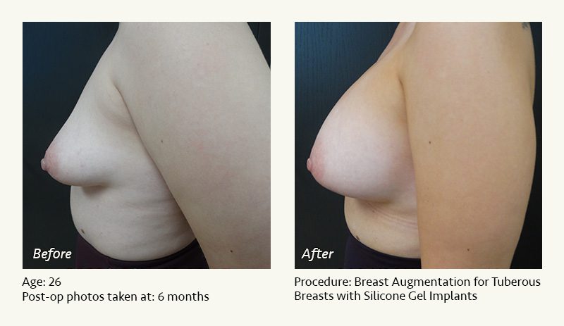 Breast Augmentation in Plano, TX - Patient 20
