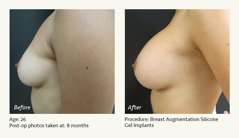 Breast Augmentation in Plano, TX - Patient 22