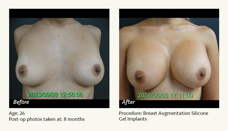 Breast Augmentation in Plano, TX - Patient 21