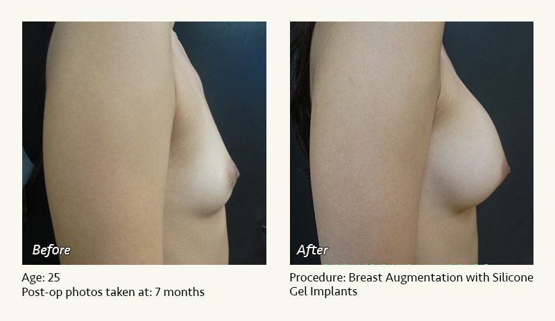 Breast Augmentation in Plano, TX - Patient 18