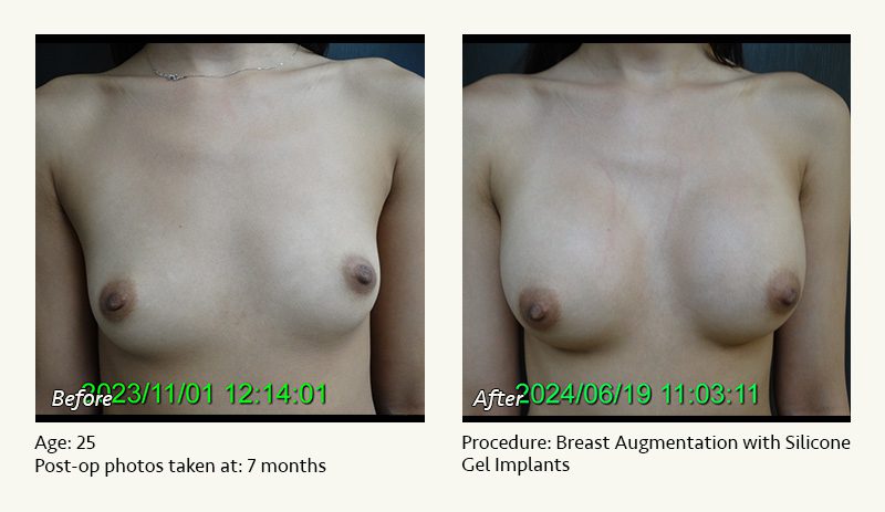 Breast Augmentation in Plano, TX - Patient 17