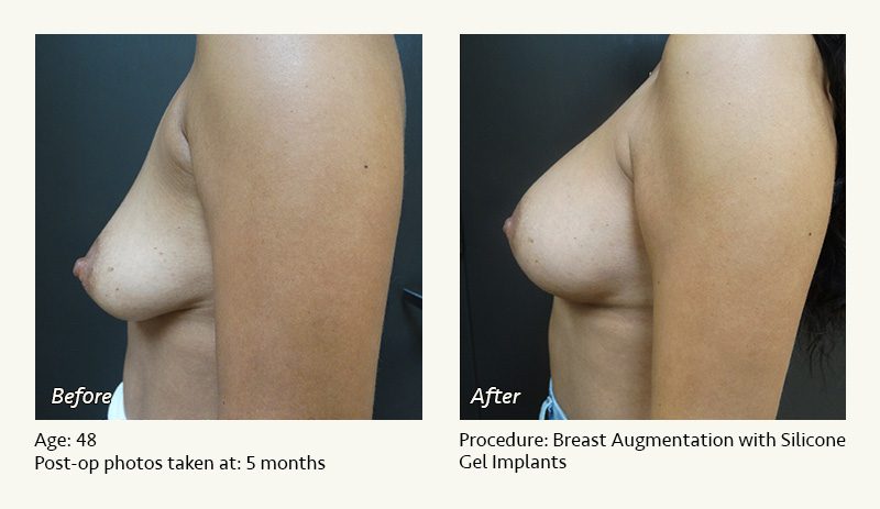 Breast Augmentation in Plano, TX - Patient 16
