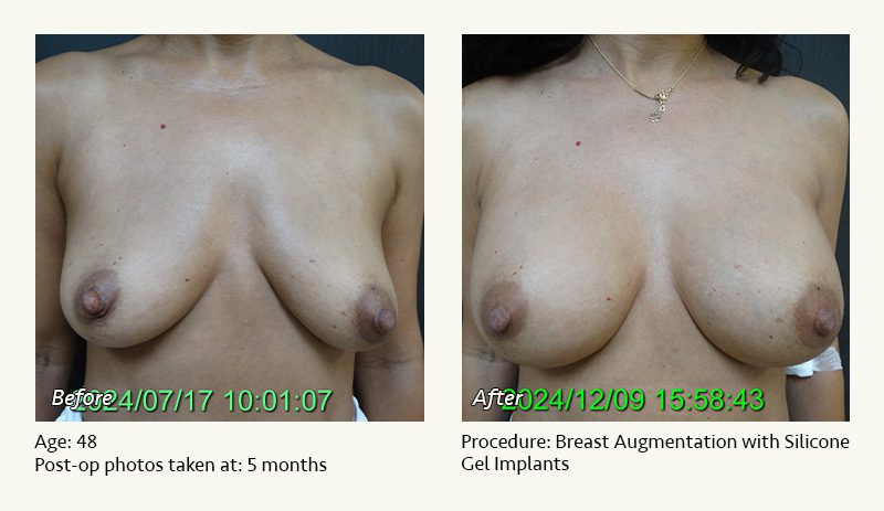 Breast Augmentation in Plano, TX - Patient 15