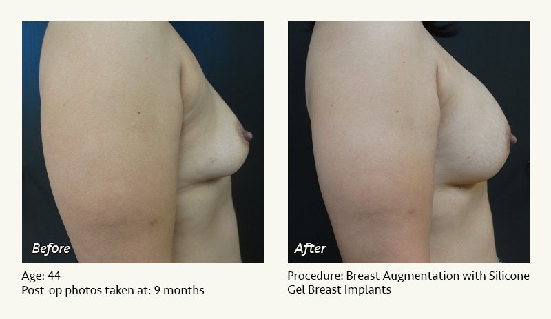 Breast Augmentation in Plano, TX - Patient 14