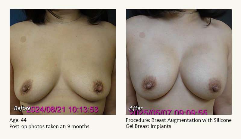 Breast Augmentation in Plano, TX - Patient 13