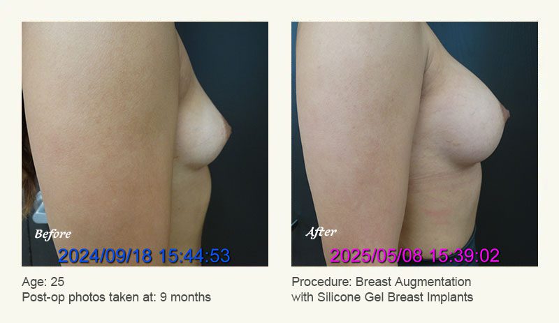 Breast Augmentation in Plano, TX - Patient 12
