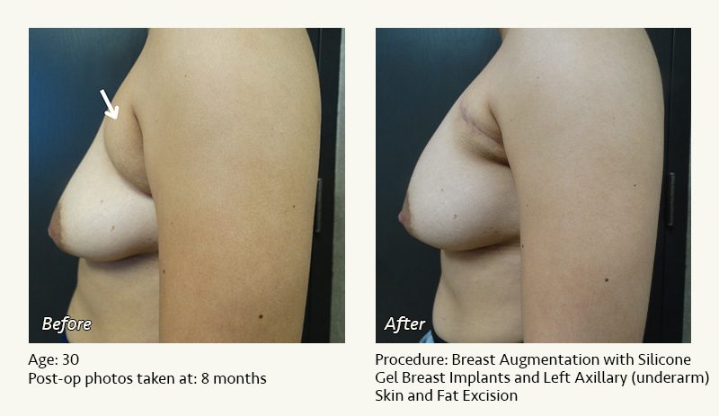 Breast Augmentation in Plano, TX - Patient 10