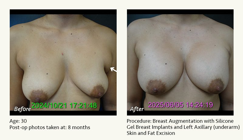 Breast Augmentation in Plano, TX - Patient 9
