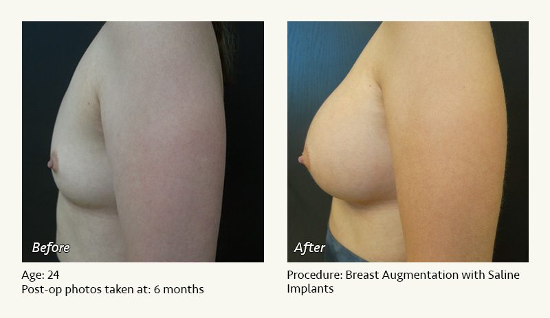 Breast Augmentation in Plano, TX - Patient 8