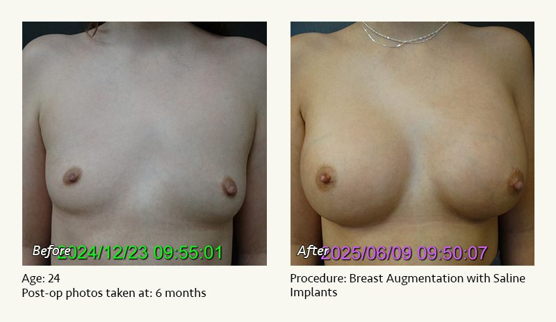 Breast Augmentation in Plano, TX - Patient 7