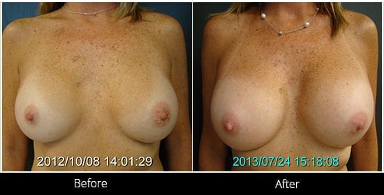 Breast Implant Revision Before & After 7 Front